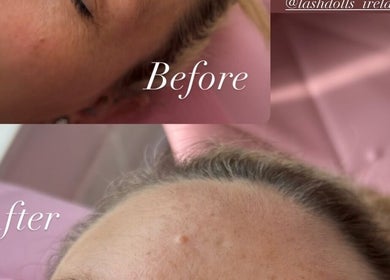 Before and after facial rejuvenation at Beautybyerika, Granard, County Longford, IE.