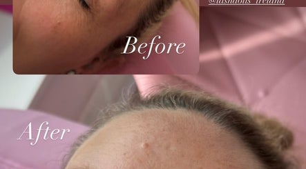 Before and after facial rejuvenation at Beautybyerika, Granard, County Longford, IE.