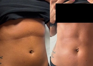 Before and after body contour results at Skin and Snatch Studio, Liverpool, England, GB.