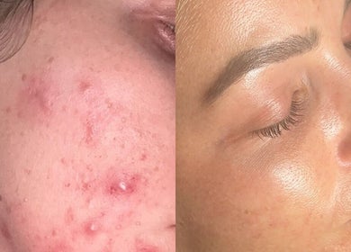 Before and after acne treatment at Skin and Snatch Studio, Liverpool, England, GB. Clear, glowing skin transformation.