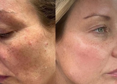 Before and after skin treatment at Skin and Snatch Studio, Liverpool, England, GB, showing clear improvement.