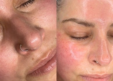 Before and after facial treatment at Skin and Snatch Studio, Liverpool, England, GB.