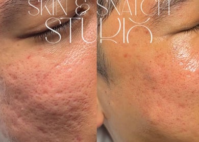 Skin transformation at Skin and Snatch Studio, Liverpool, England, GB showing before and after skincare results.