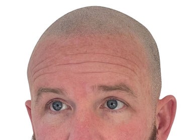 Close-up of a fresh scalp after hair treatment at EJ Hair Clinic, Keynsham, England, GB.