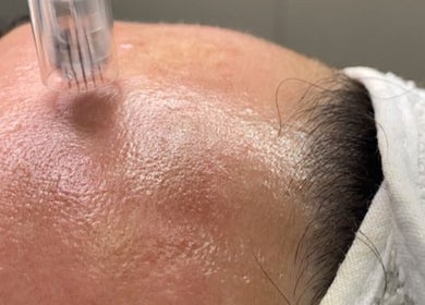 Facial treatment at Ândrea Damaceno, Roselands, New South Wales, AU showcasing skin revitalization.