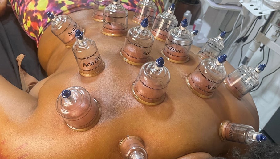 Cupping therapy session at Ree's Essence Therapy And Essentials in San Fernando, enhancing wellness naturally.