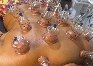 Cupping therapy session at Ree's Essence Therapy And Essentials in San Fernando, enhancing wellness naturally.