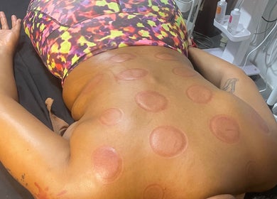 Cupping therapy at Ree's Essence Therapy And Essentials, San Fernando City Corporation, TT, showcasing wellness treatments.