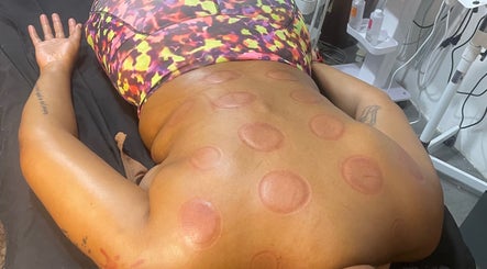 Cupping therapy at Ree's Essence Therapy And Essentials, San Fernando City Corporation, TT, showcasing wellness treatments.