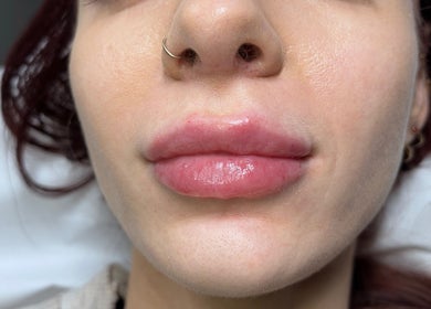 Close-up of lip enhancement at SkinNova Clinic, Edinburgh, Scotland, GB, showcasing glossy, plump lips.
