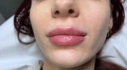 Close-up of lip enhancement at SkinNova Clinic, Edinburgh, Scotland, GB, showcasing glossy, plump lips.