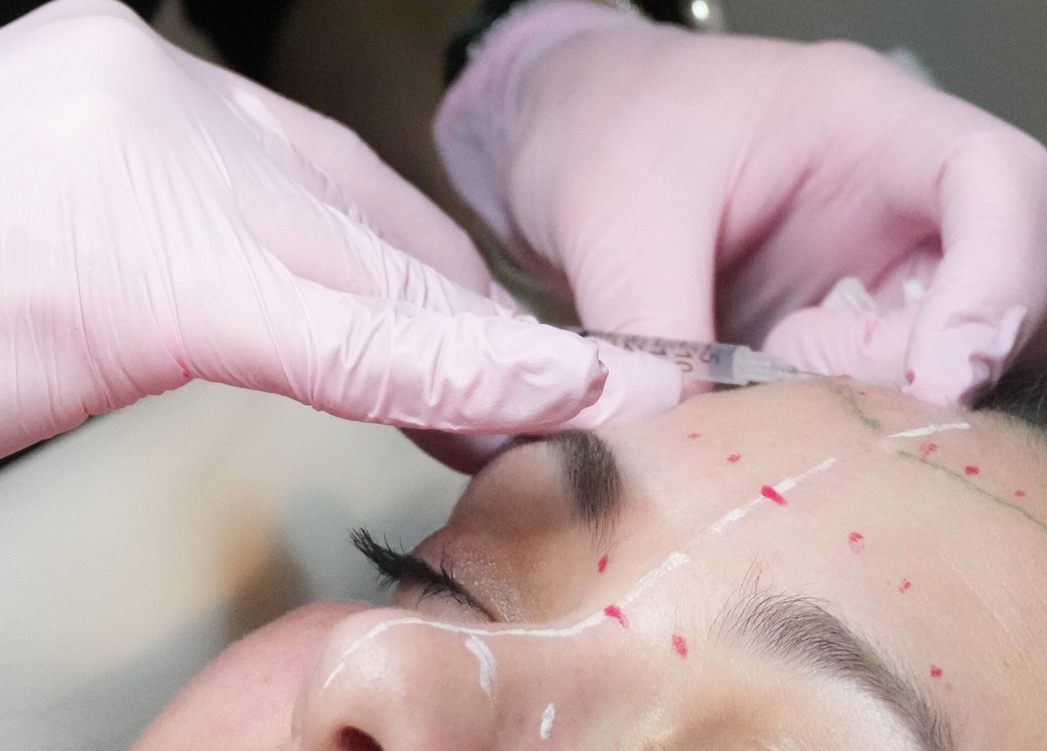 Nivelle Aesthetics in Schaumburg, Illinois, US, performing a detailed facial procedure.