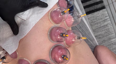 Cupping therapy session in progress at Chiro Magic, NYC, New York, US, promoting relaxation and wellness.