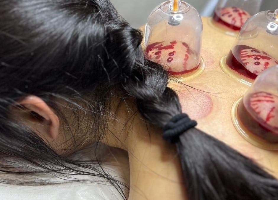 Cupping therapy at Chiro Magic, NYC, New York, US, offering wellness and relaxation.