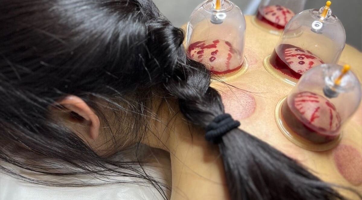 Cupping therapy at Chiro Magic, NYC, New York, US, offering wellness and relaxation.