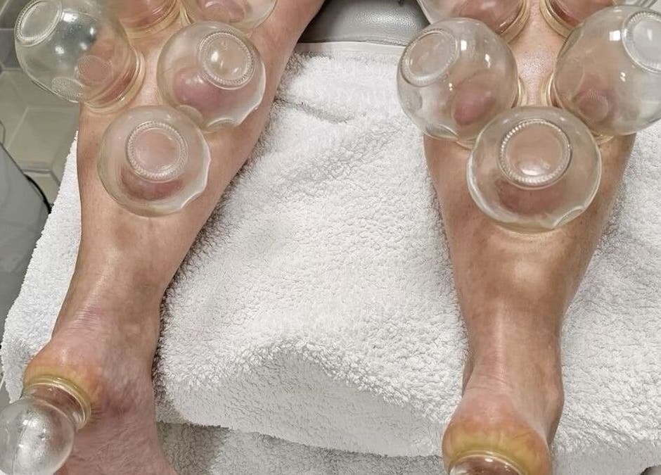Cupping therapy at Chiro Magic, NYC, New York, US, improving wellness.