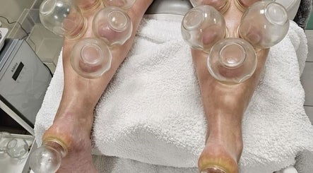 Cupping therapy at Chiro Magic, NYC, New York, US, improving wellness.