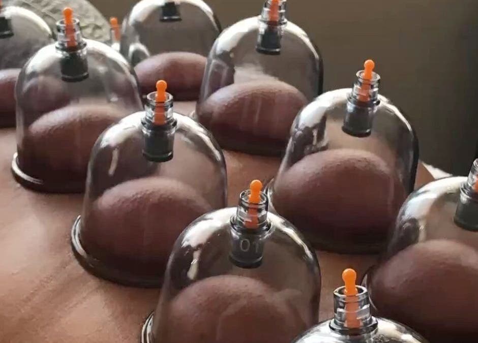 Cupping therapy session at Chiro Magic, NYC, New York, US for wellness and relaxation.