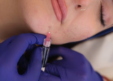Dermal filler application at Alma Aesthetics, Brighton And Hove, England, GB for chin enhancement.