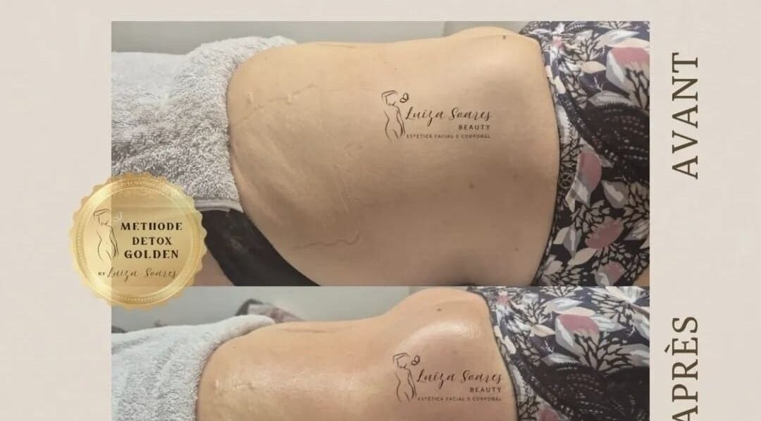 Antes e depois do tratamento Méthode Detox Golden no Luíza Soares Beauty, Luxembourg, LU. Resultados impressionantes.