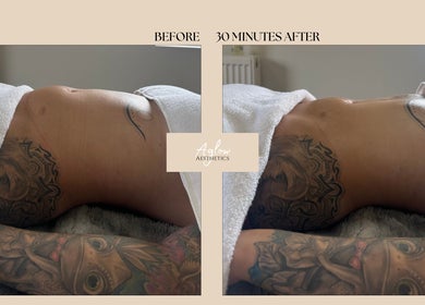 Before and after body contouring at Aglow Aesthetics, Hyde, England, GB; results visible in 30 minutes.