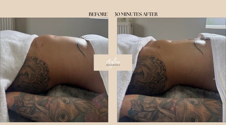 Before and after body contouring at Aglow Aesthetics, Hyde, England, GB; results visible in 30 minutes.