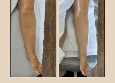 Before and after leg treatment at Aglow Aesthetics, Hyde, England, GB, showcasing smoother skin results.
