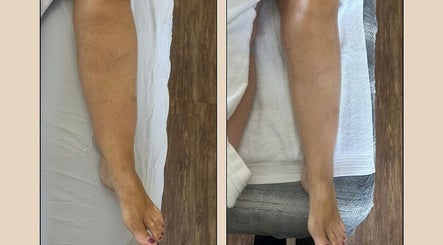 Before and after leg treatment at Aglow Aesthetics, Hyde, England, GB, showcasing smoother skin results.