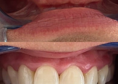 Vorher-Nachher-Foto einer Zahnbehandlung bei Zahnarztpraxis Meran, Meran, Trentino-alto Adige, IT.