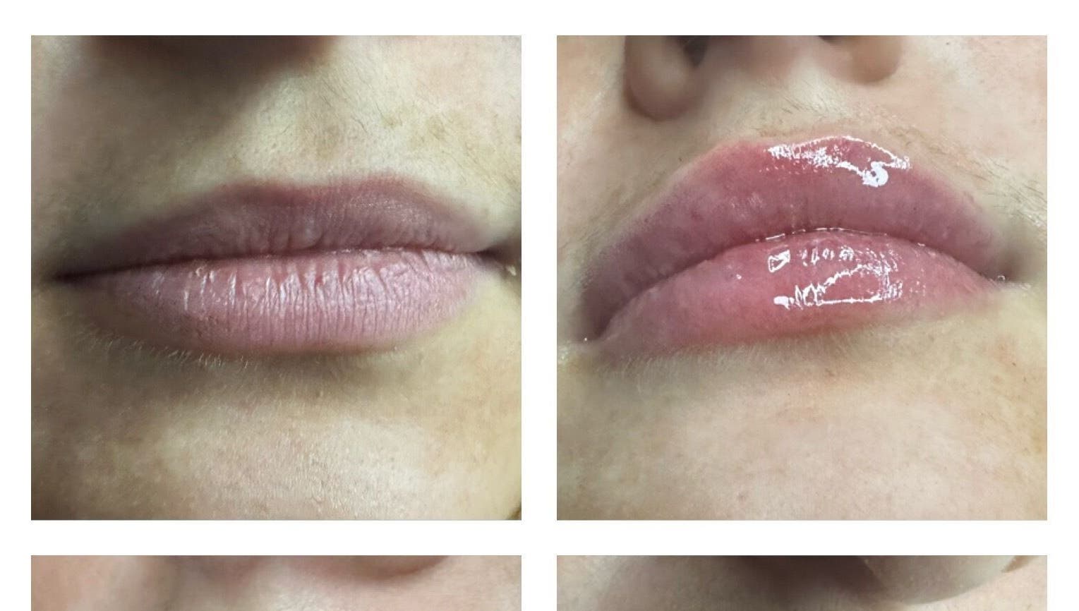 Before and after lip enhancement at Pro-Aesthetics by Amy in Birmingham, England, GB showcasing plump results.