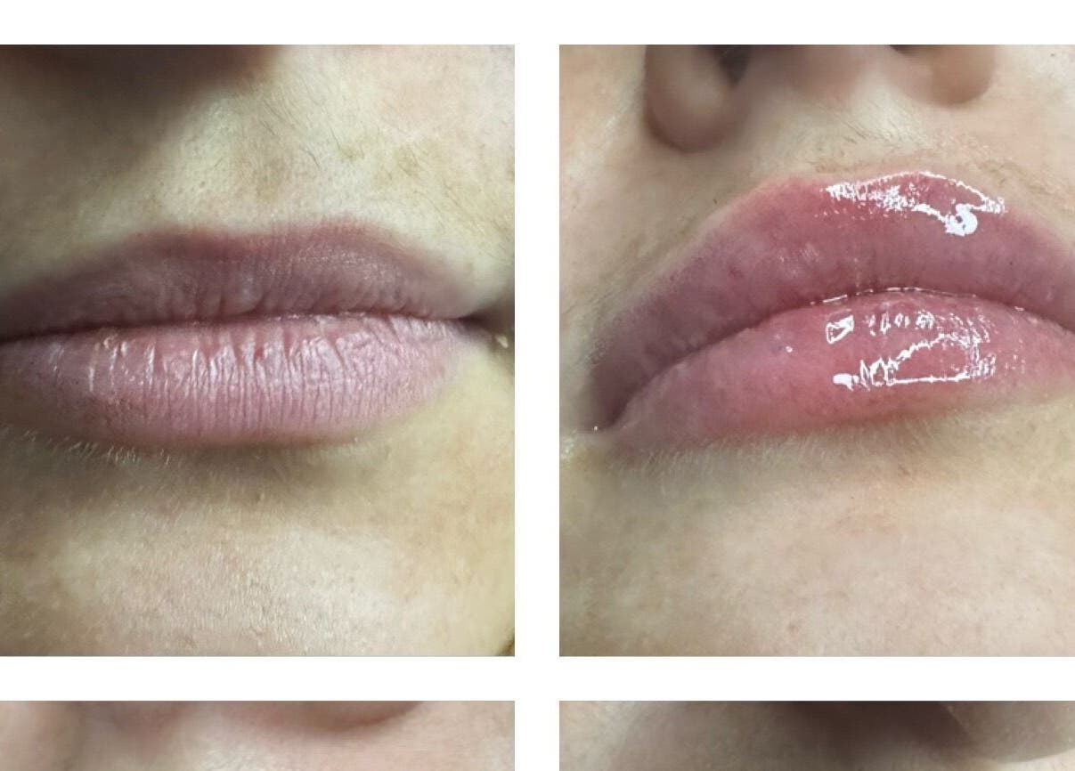 Before and after lip enhancement at Pro-Aesthetics by Amy in Birmingham, England, GB showcasing plump results.