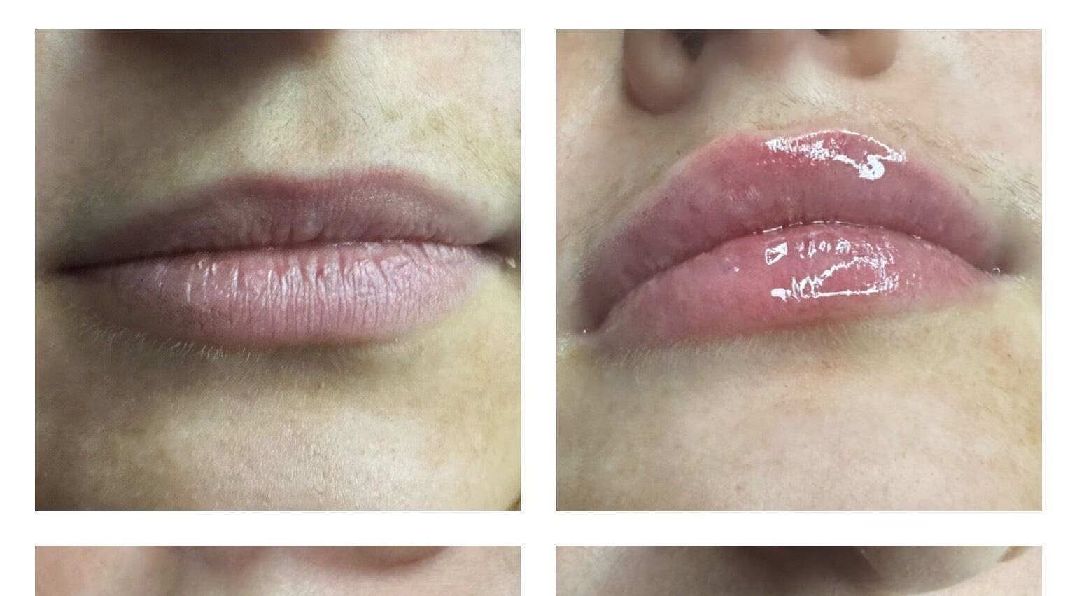 Before and after lip enhancement at Pro-Aesthetics by Amy in Birmingham, England, GB showcasing plump results.