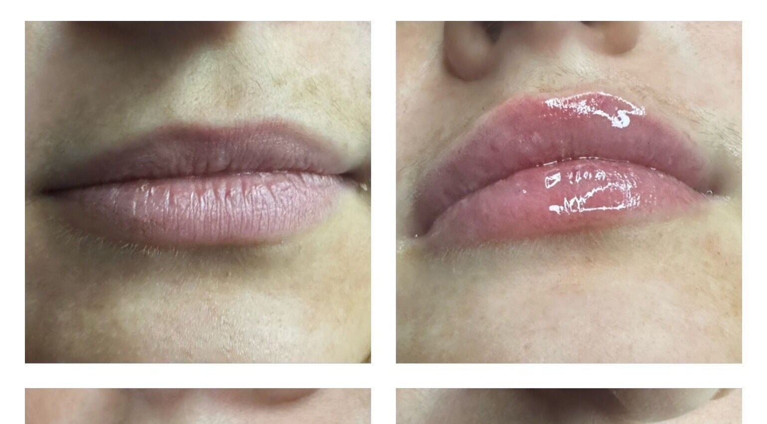Before and after lip enhancement at Pro-Aesthetics by Amy in Birmingham, England, GB showcasing plump results.