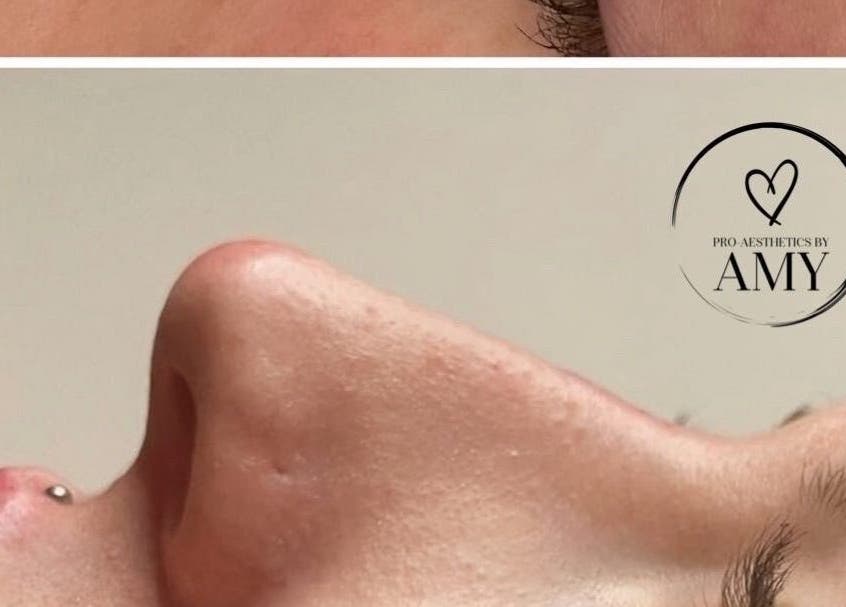 Close-up of nose enhancement at Pro-Aesthetics by Amy, Birmingham, England, GB showcasing refined elegance.