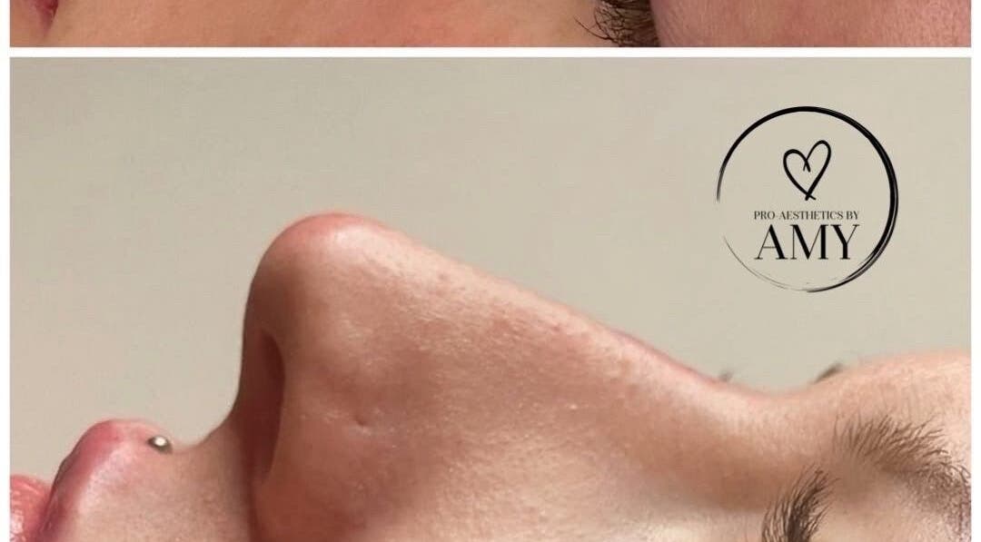 Close-up of nose enhancement at Pro-Aesthetics by Amy, Birmingham, England, GB showcasing refined elegance.