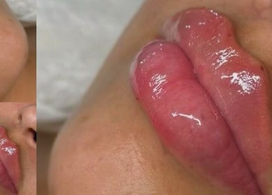 Glossy, voluminous lips after treatment at The Plump Project in Shirley, England, GB.