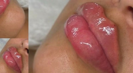 Glossy, voluminous lips after treatment at The Plump Project in Shirley, England, GB.