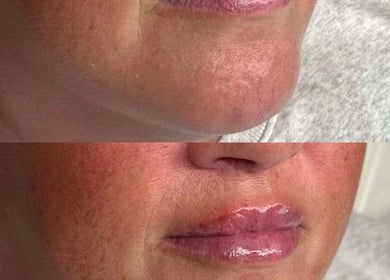 Before and after lip enhancement at Smooth Aesthetics, Glasgow, Scotland, GB.