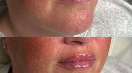 Before and after lip enhancement at Smooth Aesthetics, Glasgow, Scotland, GB.