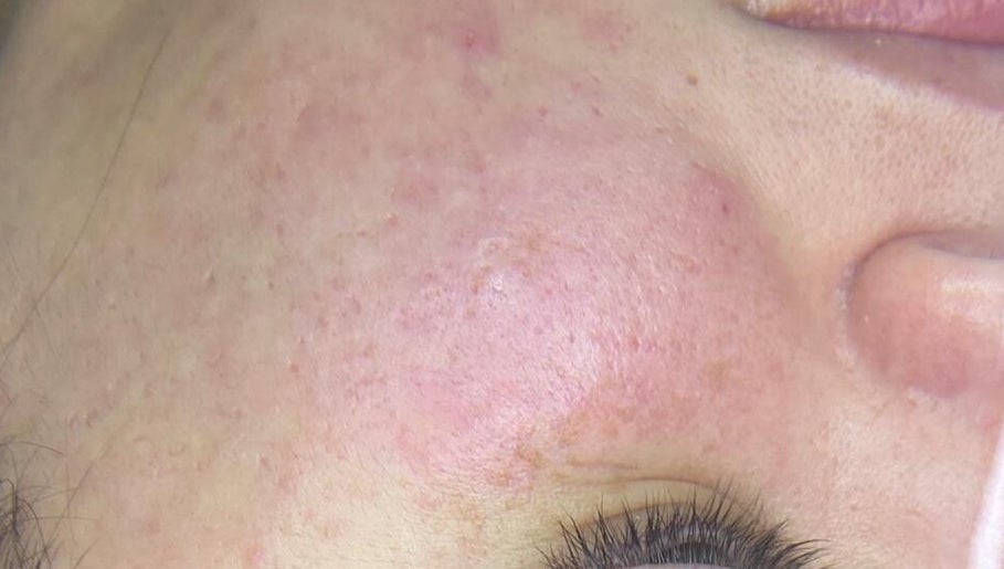 Close-up of smooth, rejuvenated skin after treatment at Foxy beauty care, San Miguel De Tucumán, Tucumán, AR.