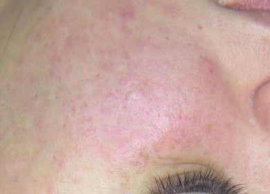 Close-up of smooth, rejuvenated skin after treatment at Foxy beauty care, San Miguel De Tucumán, Tucumán, AR.