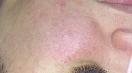 Close-up of smooth, rejuvenated skin after treatment at Foxy beauty care, San Miguel De Tucumán, Tucumán, AR.