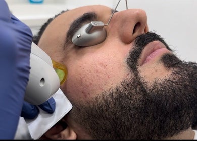 Facial laser treatment at Dalya Cosmo Clinic in London, England, GB.
