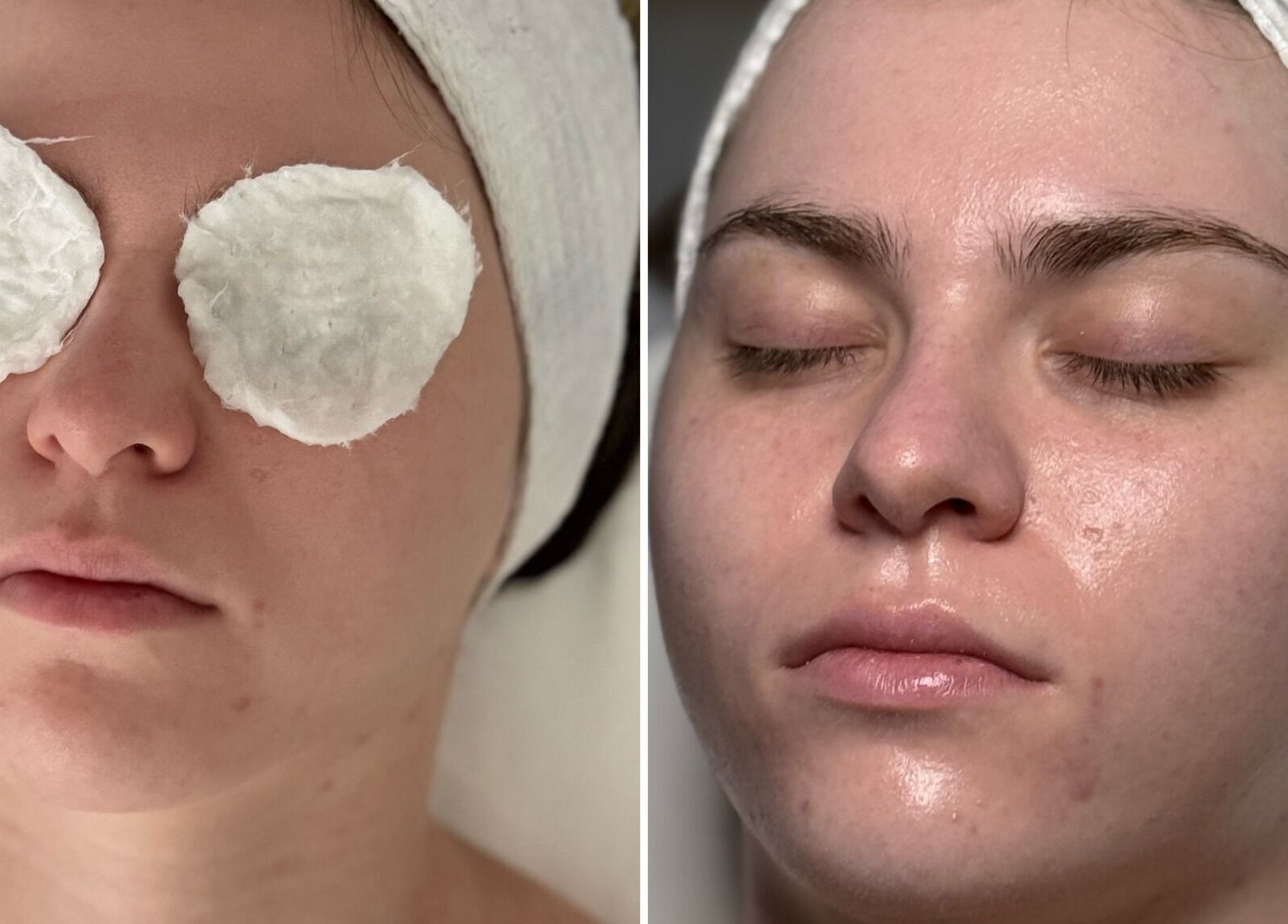 Facial treatment at Le Miracle Skin Clinic, Ottawa, Ontario, CA, showing refreshed skin after a skincare session.