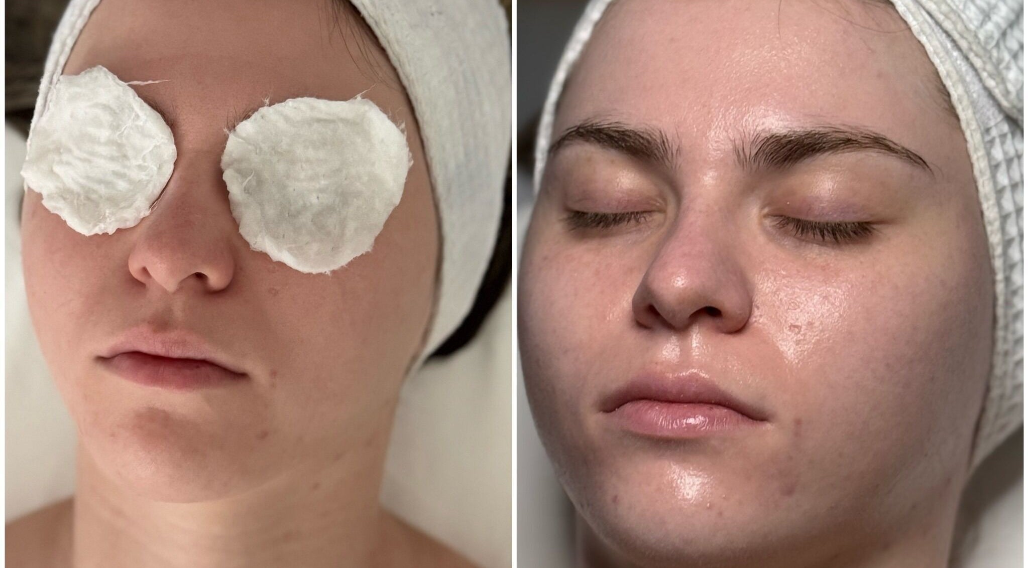 Facial treatment at Le Miracle Skin Clinic, Ottawa, Ontario, CA, showing refreshed skin after a skincare session.