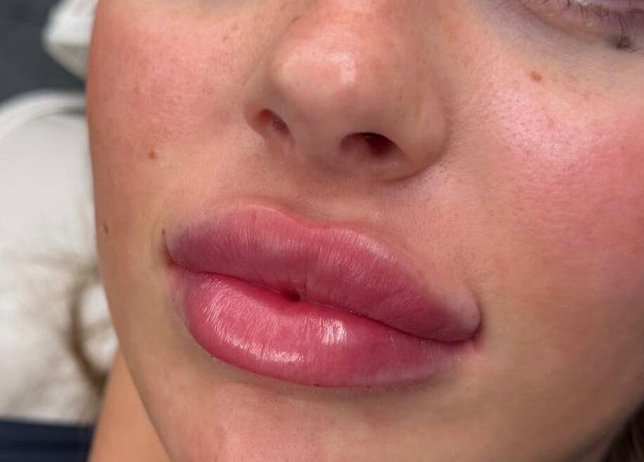 Enhanced lips after treatment at Macey Jaye Aesthetics, Leigh, England, GB. Natural, fuller lip volume.