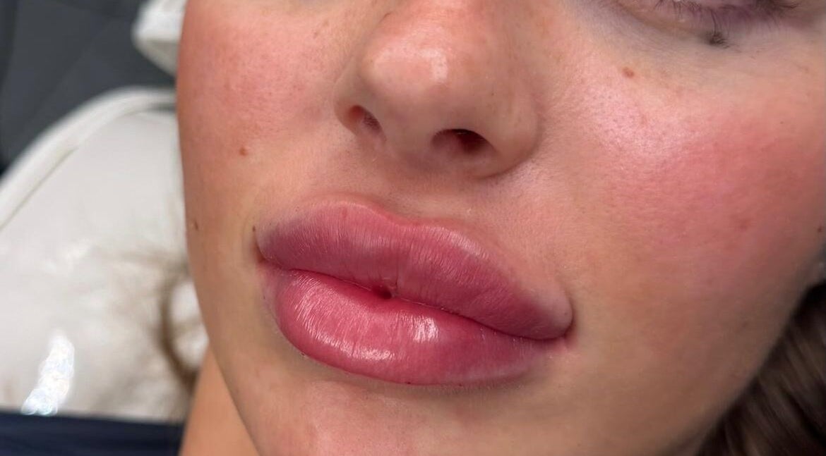 Enhanced lips after treatment at Macey Jaye Aesthetics, Leigh, England, GB. Natural, fuller lip volume.