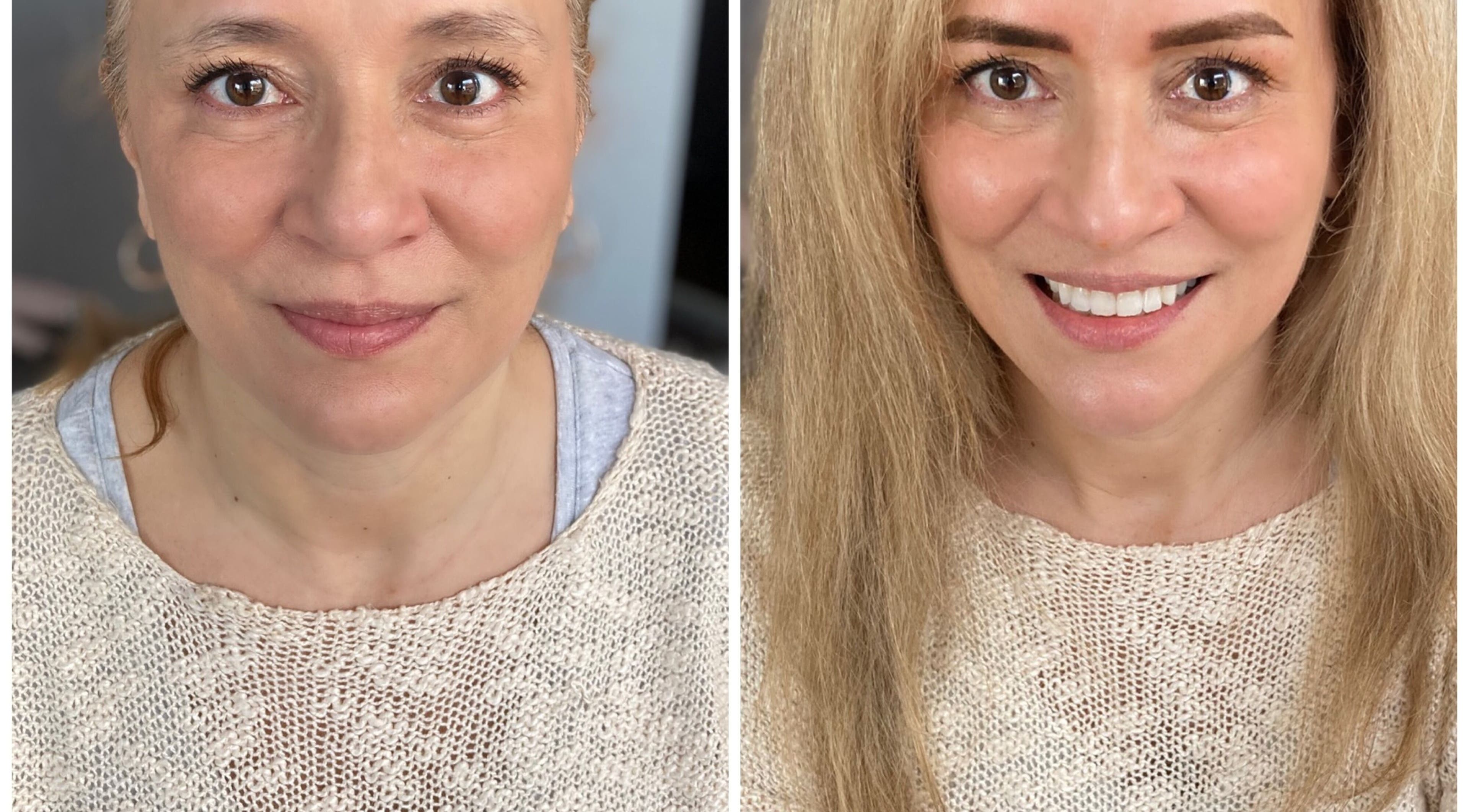 Before and after beauty treatment at SkyBeauty Valencia, València, Comunidad Valenciana, ES.