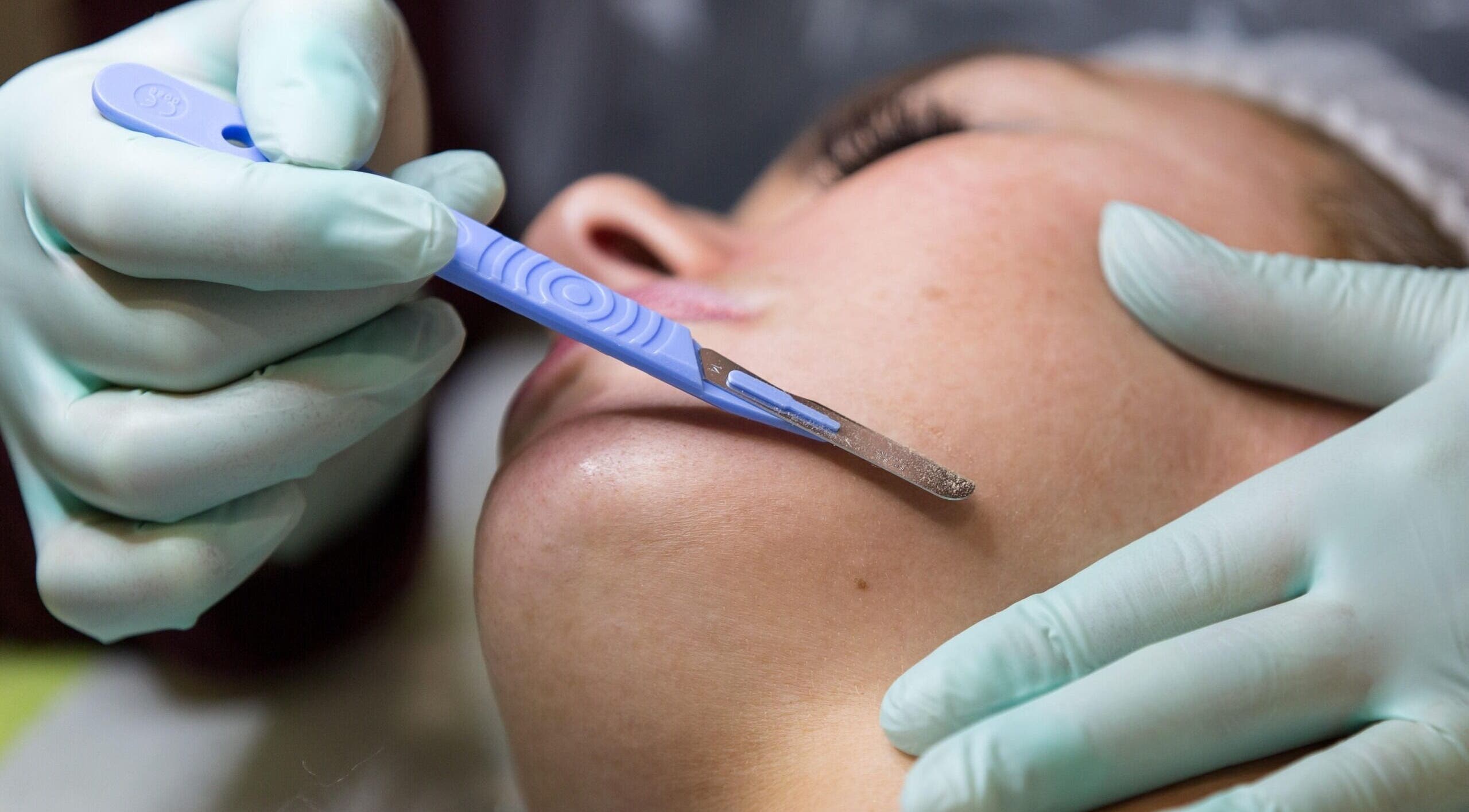 Close-up of dermaplaning treatment at L'luxe Aesthetics, Wadebridge, GB enhancing skin smoothness.