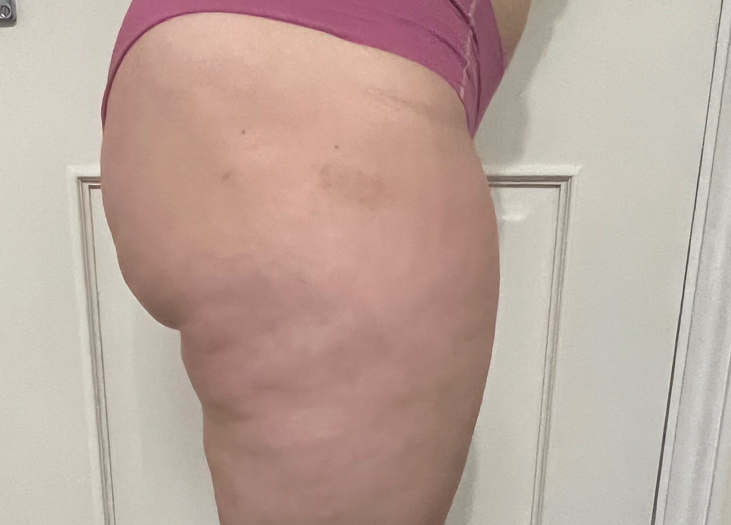 Close-up of a person's thigh at Diana Therapy, London, GB, showcasing skin texture care.